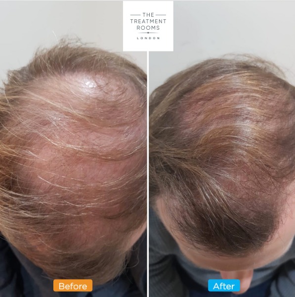 Crown Hair Transplant 6 months